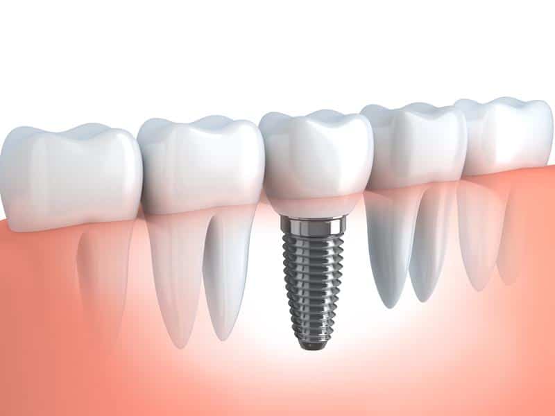Dental Implants Ocala, FL