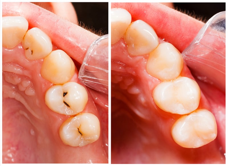Fillings Ocala, FL