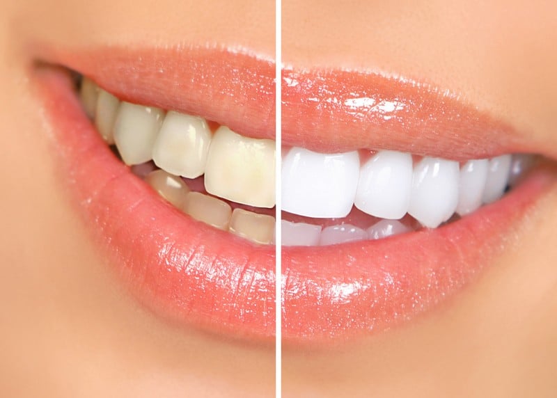 Teeth Whitening Ocala, FL